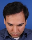 After Hair Transplant&nbsp;Front